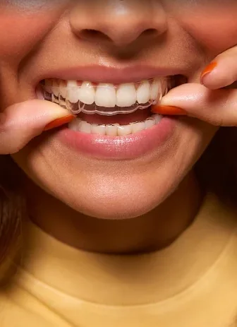 Ilustração: pessoa encaixando um alinhador transparente nos dentes superiores